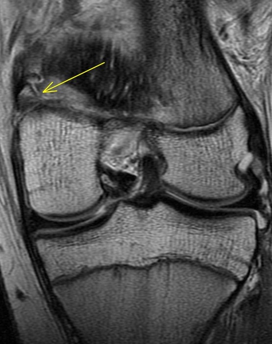 Figure 3 for case Avulsion fracture of the adductor magnus insertion